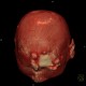 Merkel cell carcinoma, recurrence: CT - Computed tomography
